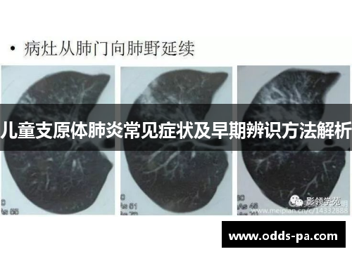 儿童支原体肺炎常见症状及早期辨识方法解析